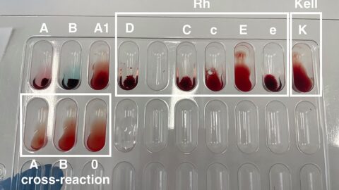 Single-Cell Tests Aim to Catch Returning Leukemia Earlier