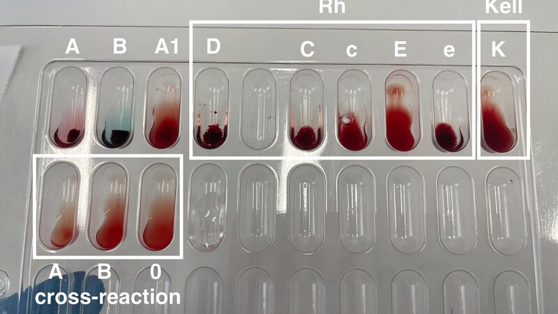 Single-Cell Tests Aim to Catch Returning Leukemia Earlier