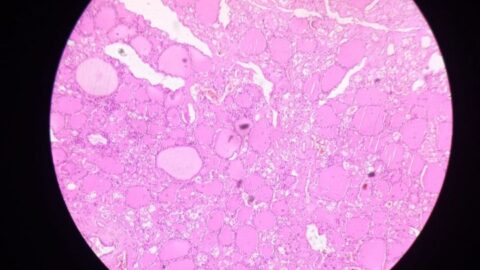 Thyroid gland tissue seen under a microscope, showing the follicles that produce thyroid hormones