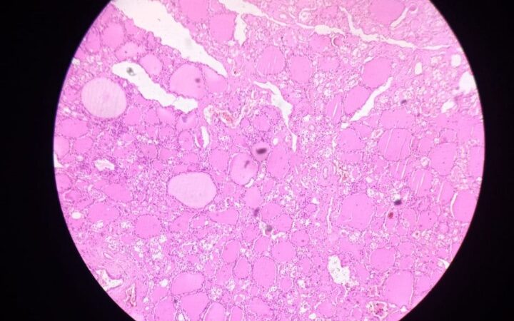 Thyroid gland tissue seen under a microscope, showing the follicles that produce thyroid hormones