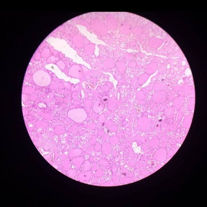 Thyroid gland tissue seen under a microscope, showing the follicles that produce thyroid hormones